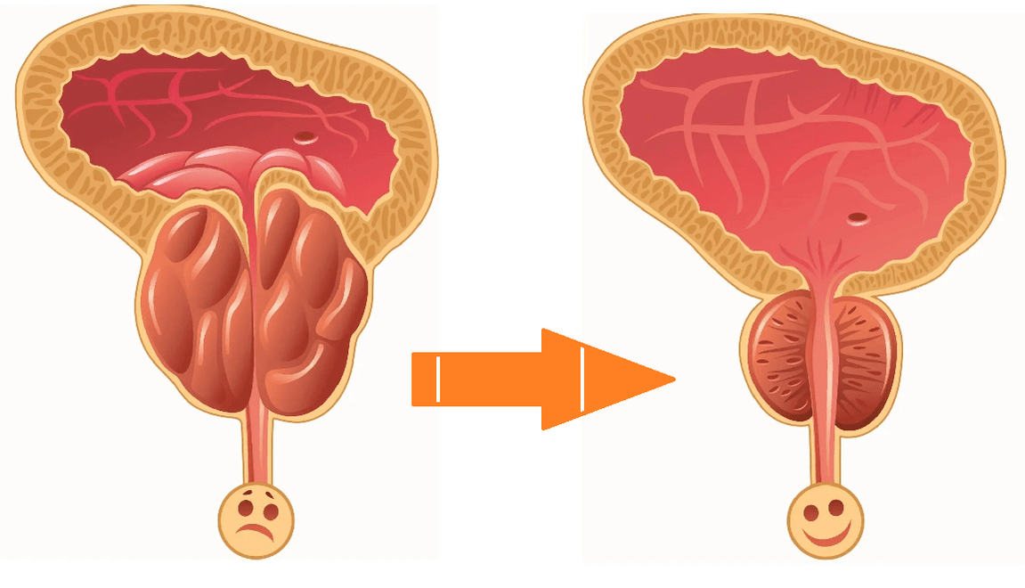 Uromexil Forte Ação sobre próstata com prostatite e adenoma