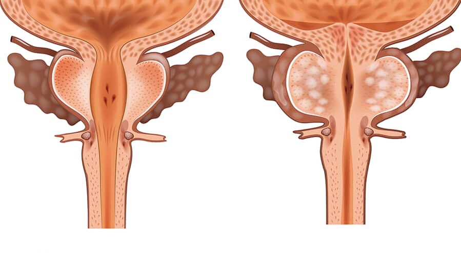 comparação de adenoma saudável e inflamado