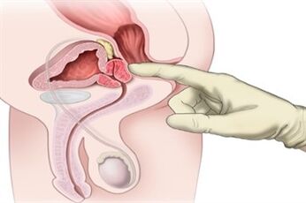 Massagem de próstata para tratamento de prostatite crônica
