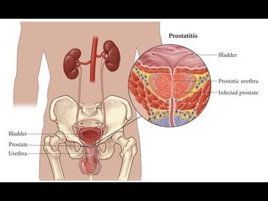 Prostatite – inflamação da próstata