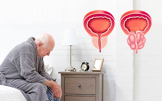prostatite em um homem